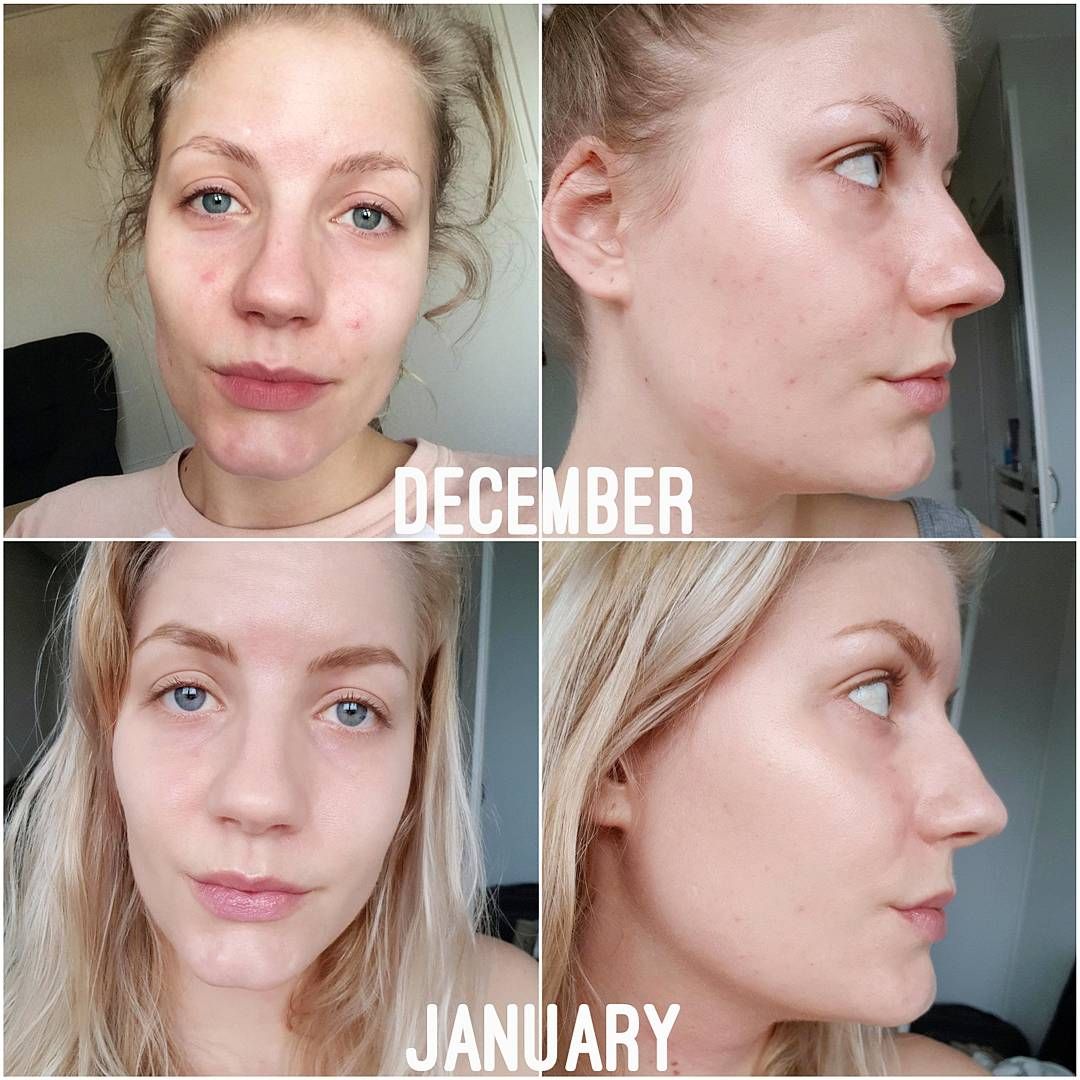 The Ordinary Niacinamide 10% + Zinc 1% (Oil Control,Minimize Pores & blemishes)